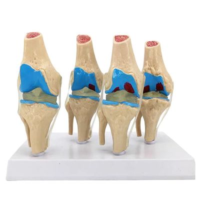 Démonstration anatomique du modèle de pathologie articulaire du genou humain pour la science médicale