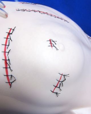 Modèle réaliste d'enseignement de l'appendicectomie pour les compétences de pansement et de suture