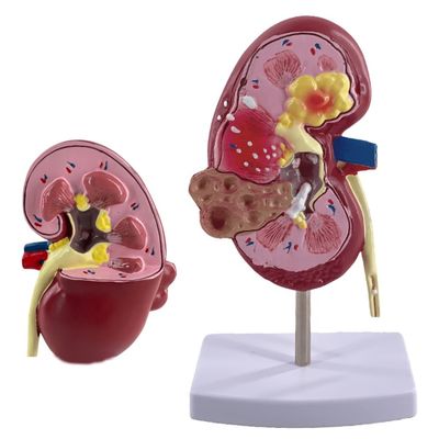 Modèle de rein pathologique en PVC pour les écoles de médecine et les hôpitaux d'urologie