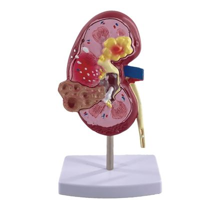 Modèle de rein pathologique en PVC pour les écoles de médecine et les hôpitaux d'urologie