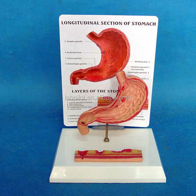 Modèle éducatif avancé en PVC pour la représentation de l'ulcère gastrique de l'estomac humain