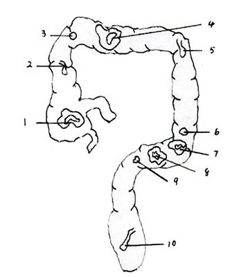 Modèle d'anatomie du rectum et du côlon Simulateur d'endoscopie intestinale en PVC avancé